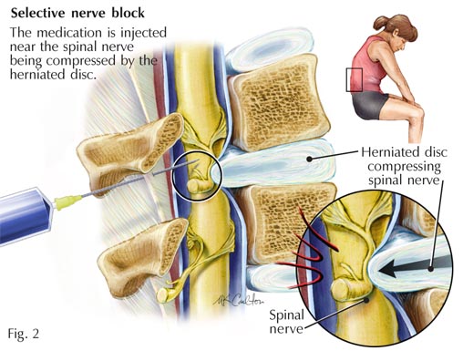 nerve-root-block